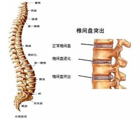 腰椎间盘膨出的治疗方法有哪些