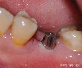 牙植骨要注意事项