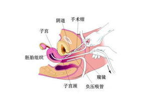 产后刮宫后注意事项