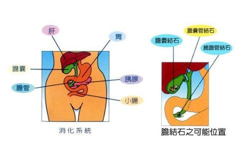 胆结石注意事项及饮食,胆结石患者注意事项,胆结石微创手术注意事项