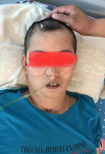 昏迷患者鼻饲注意事项