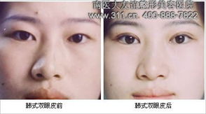 韩式微创双眼皮术后注意事项,韩式双眼皮术后注意事项有哪些,双眼皮术后注意事项及护理