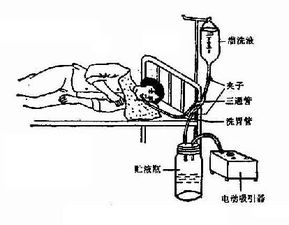 注意事项,插管