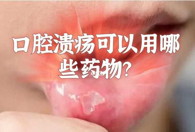 治口腔溃疡的好方法