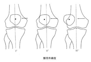 髌骨典故