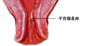 宫颈息肉摘除有哪些方法