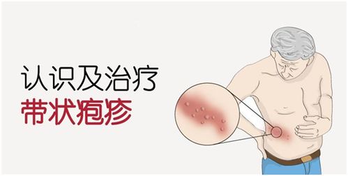 治疗疱疹的最好土方法有哪些