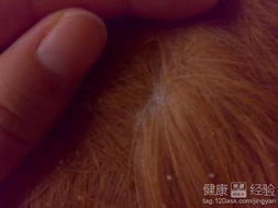 治头皮屑的有效方法有哪些