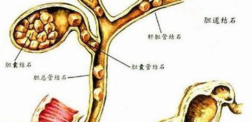 胆石症有哪些治疗方法