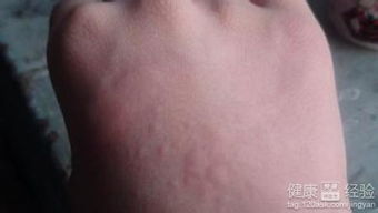 人工性荨麻疹根治方法有哪些