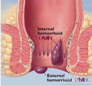 治疗痔疮病有什么方法有哪些