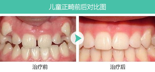 小儿牙齿矫正方法有哪些