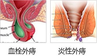 外痔疮有什么治疗的方法有哪些方法有哪些