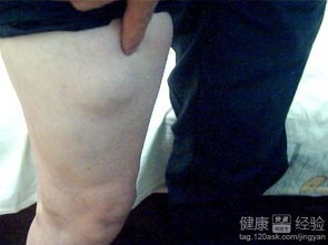 脂肪瘤的中医治疗方法有哪些
