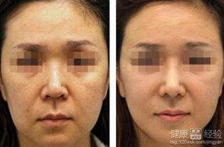 全面部提升有哪些手术方法