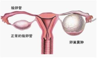 卵巢囊肿治疗效果好的方法有哪些