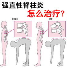 强直性脊柱炎运动方法有哪些方法有哪些