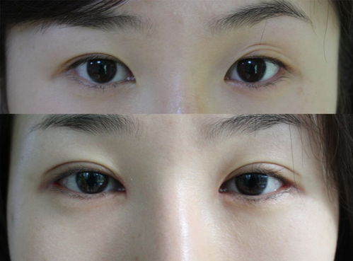 韩式双眼皮恢复方法有哪些