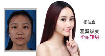 让内双变外双眼皮的方法有哪些