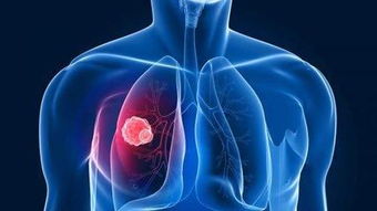 肺癌晚期还能做哪些治疗方法