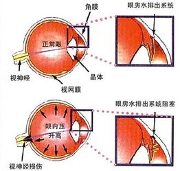 眼压检查的方法有哪些
