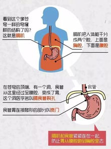 治疗食管裂孔疝最好的方法有哪些