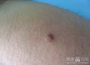 病毒病毒疣有哪些治疗方法