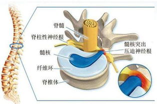 腰椎间盘突出症状治疗有哪些方法及治