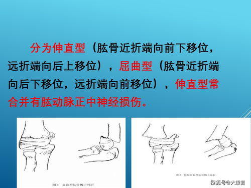 上肢骨折固定方法有哪些多选题