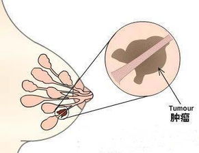 乳腺术后护理方法有哪些