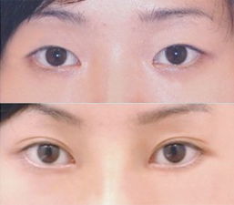 非手术双眼皮方法有哪些方法有哪些