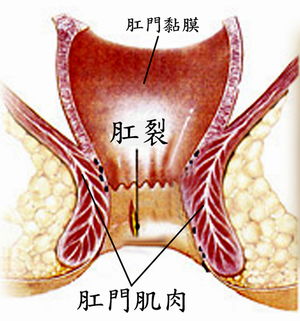 肛裂有效的治疗方法有哪些