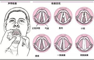 声带小结手术需不需要住院(需不需要作文)