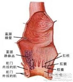 直肠造口注意事项