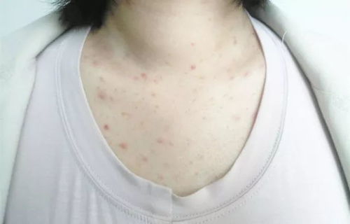 疥疮,注意事项,毛囊炎