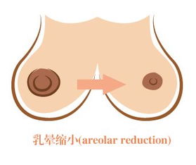 做乳晕变小手术注意事项,乳晕注射注意事项,激光乳晕嫩红术注意事项