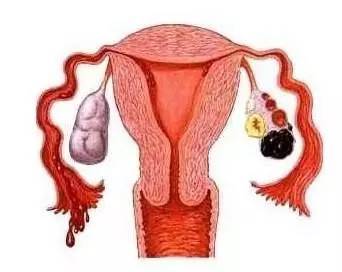 左侧卵巢囊肿饮食注意事项,左侧卵巢囊肿需要注意事项,左侧卵巢囊肿术后注意事项
