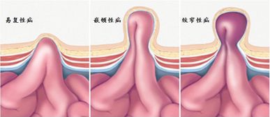 疝气全麻手术后注意事项