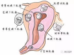 子宫肌瘤患者月经期注意事项