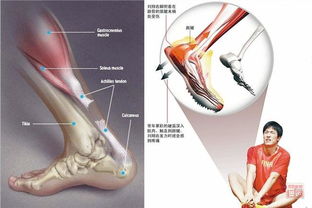 跟腱术后注意事项,跟腱受伤注意事项,穿跟腱靴注意事项