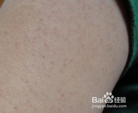 腿上鸡皮疙瘩注意事项