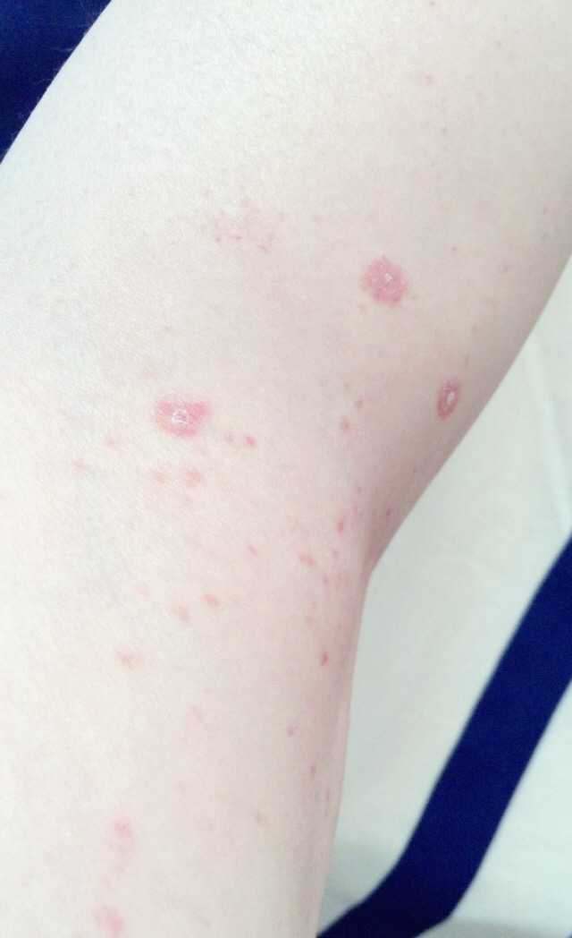 得了玫瑰糠疹注意什么,玫瑰糠疹注意事项,玫瑰种植方法和注意事项