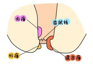 痔疮术后十大注意事项,痔疮手术后的注意事项,痔疮术后注意事项及饮食禁忌