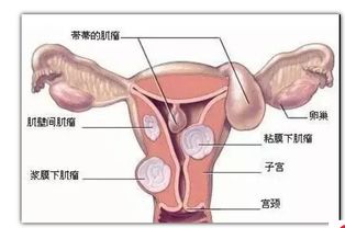 子宫肌瘤怀孕后注意事项
