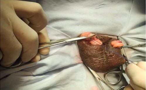 睾丸摘除手术步骤图图片