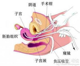 堕胎,药物,注意事项
