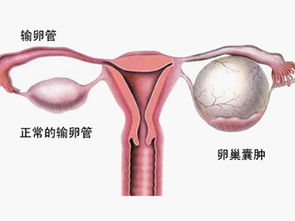腹腔镜卵巢囊肿手术后注意事项