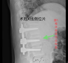 腰椎骨折手术术中注意事项