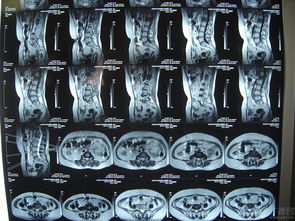 腰椎压缩性骨折后饮食注意事项