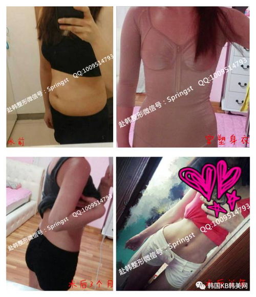 做手臂吸脂后都有哪些注意事项